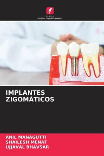 IMPLANTES ZIGOMÁTICOS