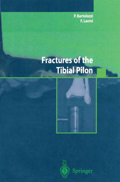 Fractures of the Tibial Pilon