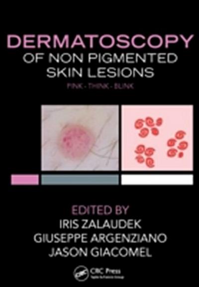 Dermatoscopy of Non-Pigmented Skin Tumors