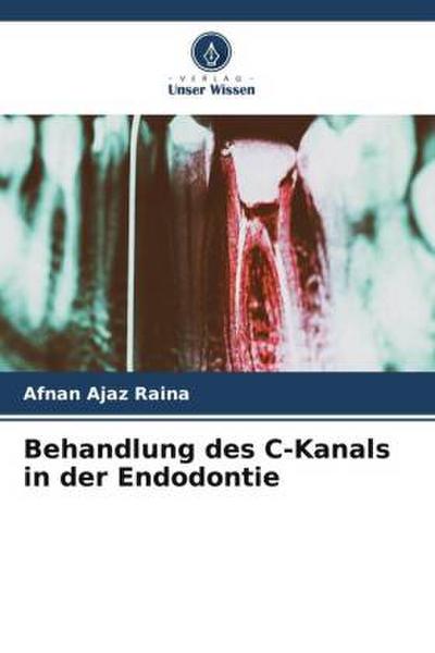 Behandlung des C-Kanals in der Endodontie