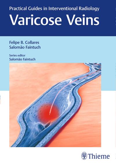 Varicose Veins: Practical Guides in Interventional Radiology