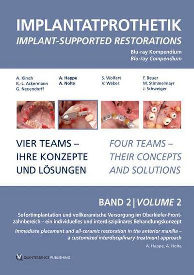 Implantatprothetik. Blu-Ray, Band 2