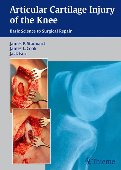 Articular Cartilage Injury of the Knee: Basic Science to Surgical Repair