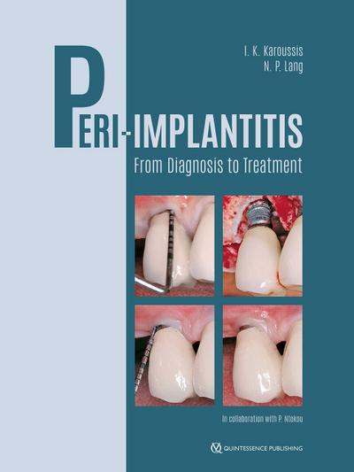 Peri-Implantitis