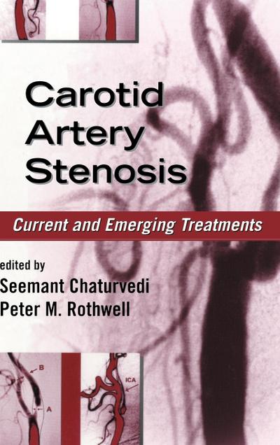 Carotid Artery Stenosis
