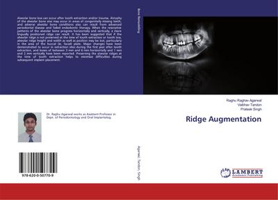 Ridge Augmentation