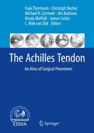 The Achilles Tendon