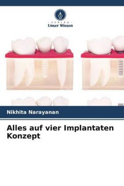 Alles auf vier Implantaten Konzept