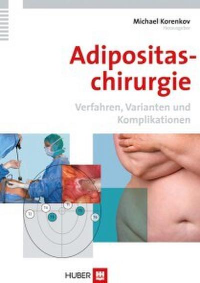 Adipositaschirurgie