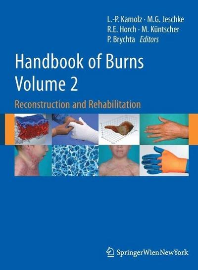 Handbook of Burns Volume 2