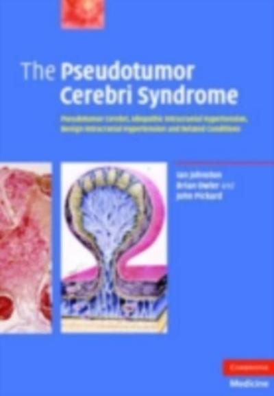 Pseudotumor Cerebri Syndrome