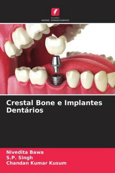 Crestal Bone e Implantes Dentários