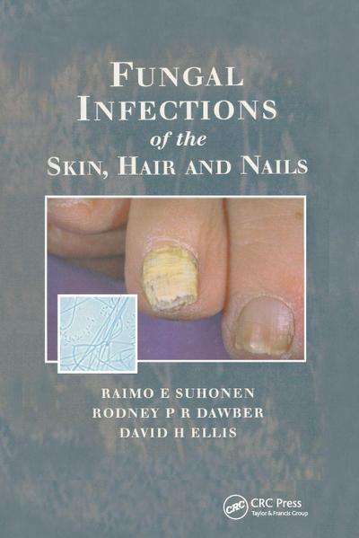Fungal Infections of the Skin and Nails