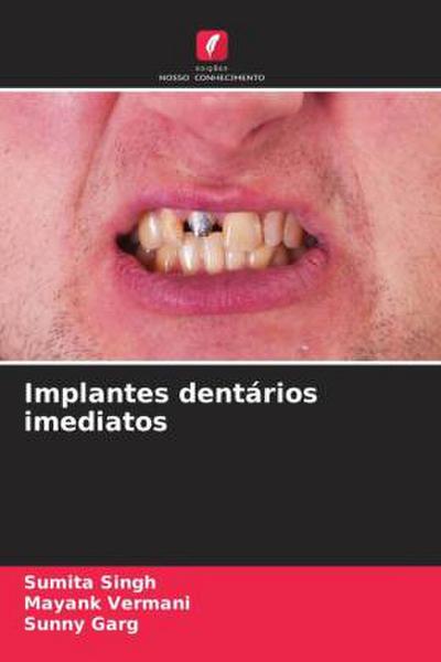 Implantes dentários imediatos