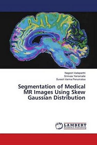 Segmentation of Medical MR Images Using Skew Gaussian Distribution