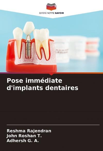 Pose immédiate d’implants dentaires