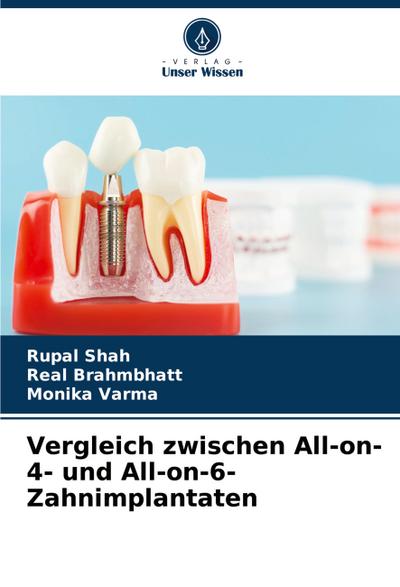 Vergleich zwischen All-on-4- und All-on-6-Zahnimplantaten