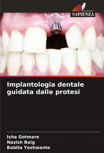 Implantologia dentale guidata dalle protesi