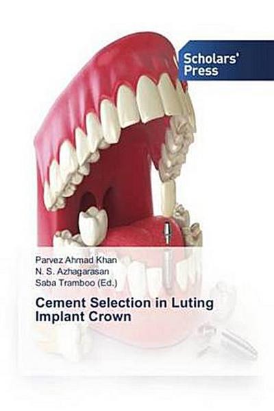 Cement Selection in Luting Implant Crown