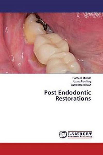 Post Endodontic Restorations