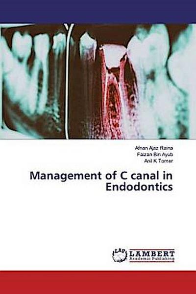 Management of C canal in Endodontics
