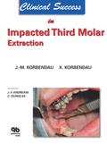 Clinical Success in Impacted Third Molar Extractio