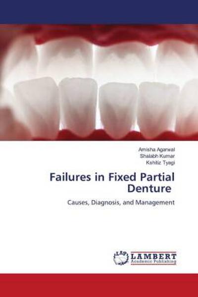 Failures in Fixed Partial Denture