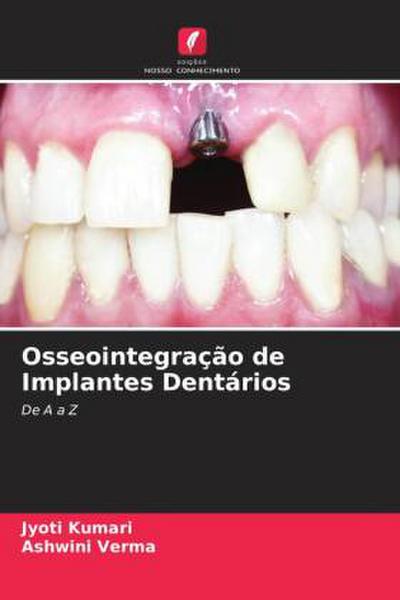 Osseointegração de Implantes Dentários