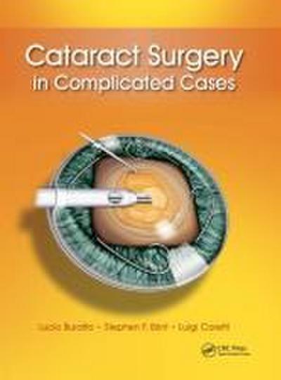 Cataract Surgery in Complicated Cases