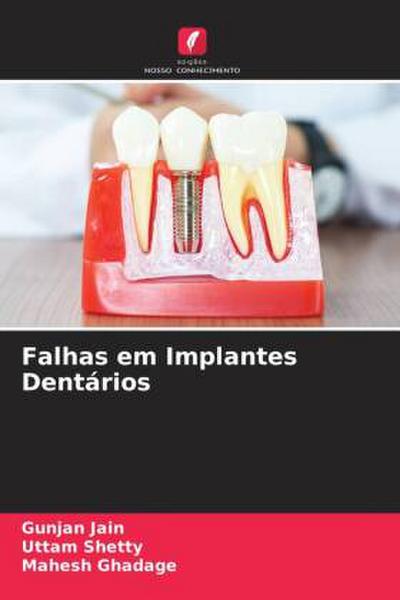 Falhas em Implantes Dentários
