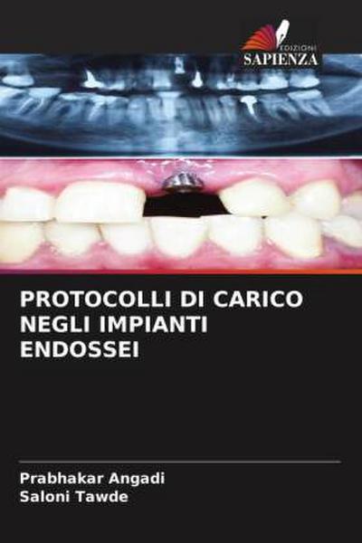 PROTOCOLLI DI CARICO NEGLI IMPIANTI ENDOSSEI