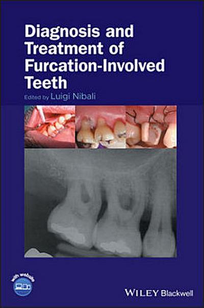 Diagnosis and Treatment of Furcation-Involved Teeth