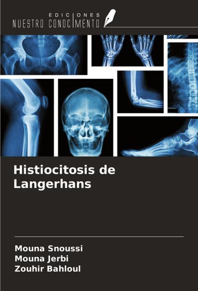 Histiocitosis de Langerhans