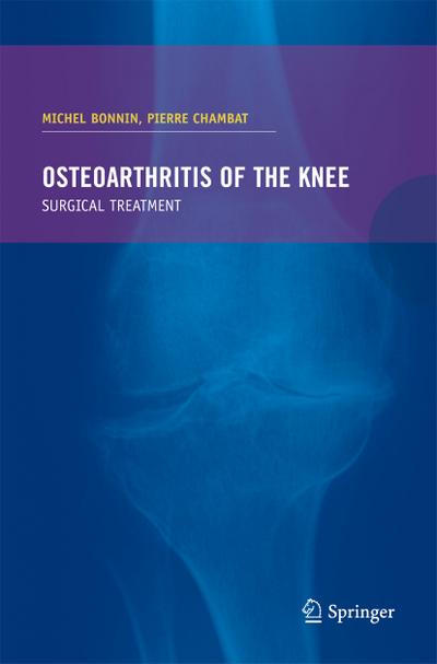 Osteoarthrisis of the knee