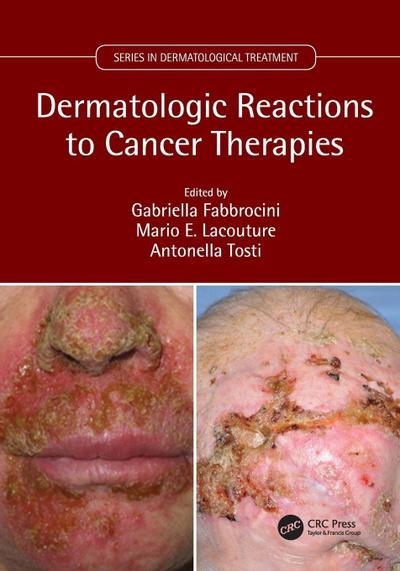 Dermatologic Reactions to Cancer Therapies