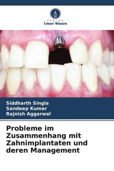 Probleme im Zusammenhang mit Zahnimplantaten und deren Management