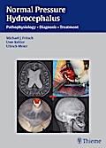 Normal Pressure Hydrocephalus