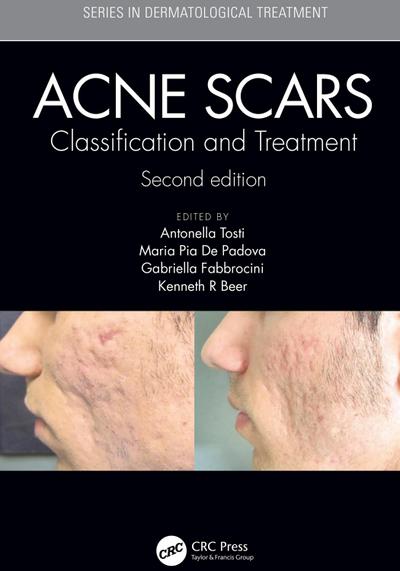 Acne Scars