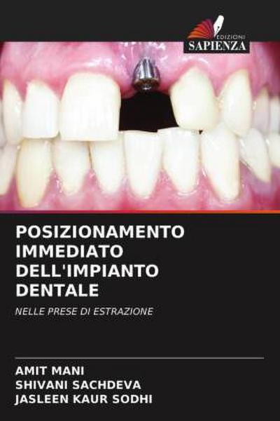 POSIZIONAMENTO IMMEDIATO DELL’IMPIANTO DENTALE
