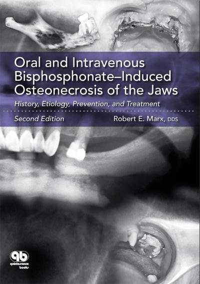 Oral and Intravenous Bisphosphonate–Induced Osteonecrosis of the Jaws (eBook, PDF) - Robert E. Marx