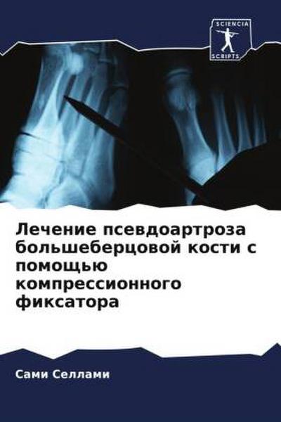 Lechenie psewdoartroza bol’shebercowoj kosti s pomosch’ü kompressionnogo fixatora