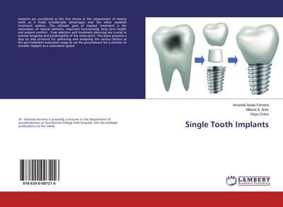 Single Tooth Implants