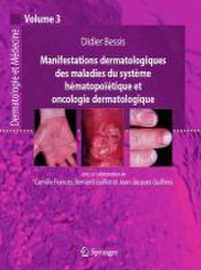 Manifestations dermatologiques des maladies du système hématopoïétique et oncologie dermatologique