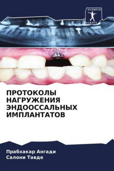 PROTOKOLY NAGRUZhENIYa JeNDOOSSAL’NYH IMPLANTATOV
