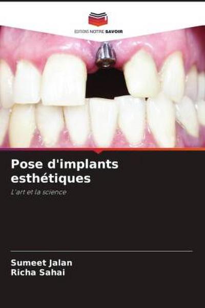 Pose d’implants esthétiques