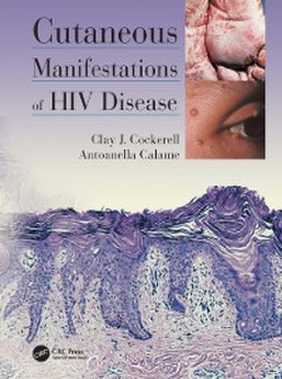 Cutaneous Manifestations of HIV Disease