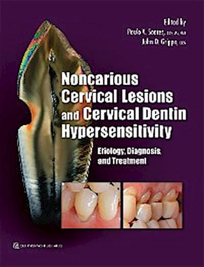 Noncarious Cervical Lesions and Cervical Dentin Hypersensitivity
