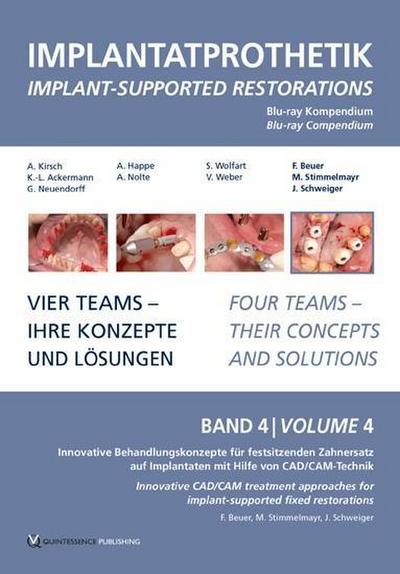 Implantatprothetik. Blu-Ray, Band 4