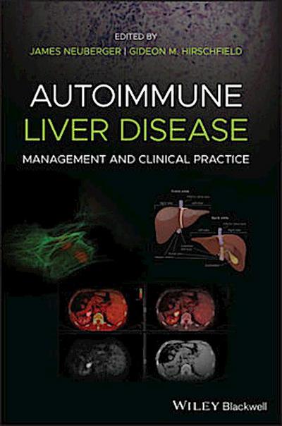 Autoimmune Liver Disease