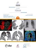 Coleção CBR Volume 13 - Tórax